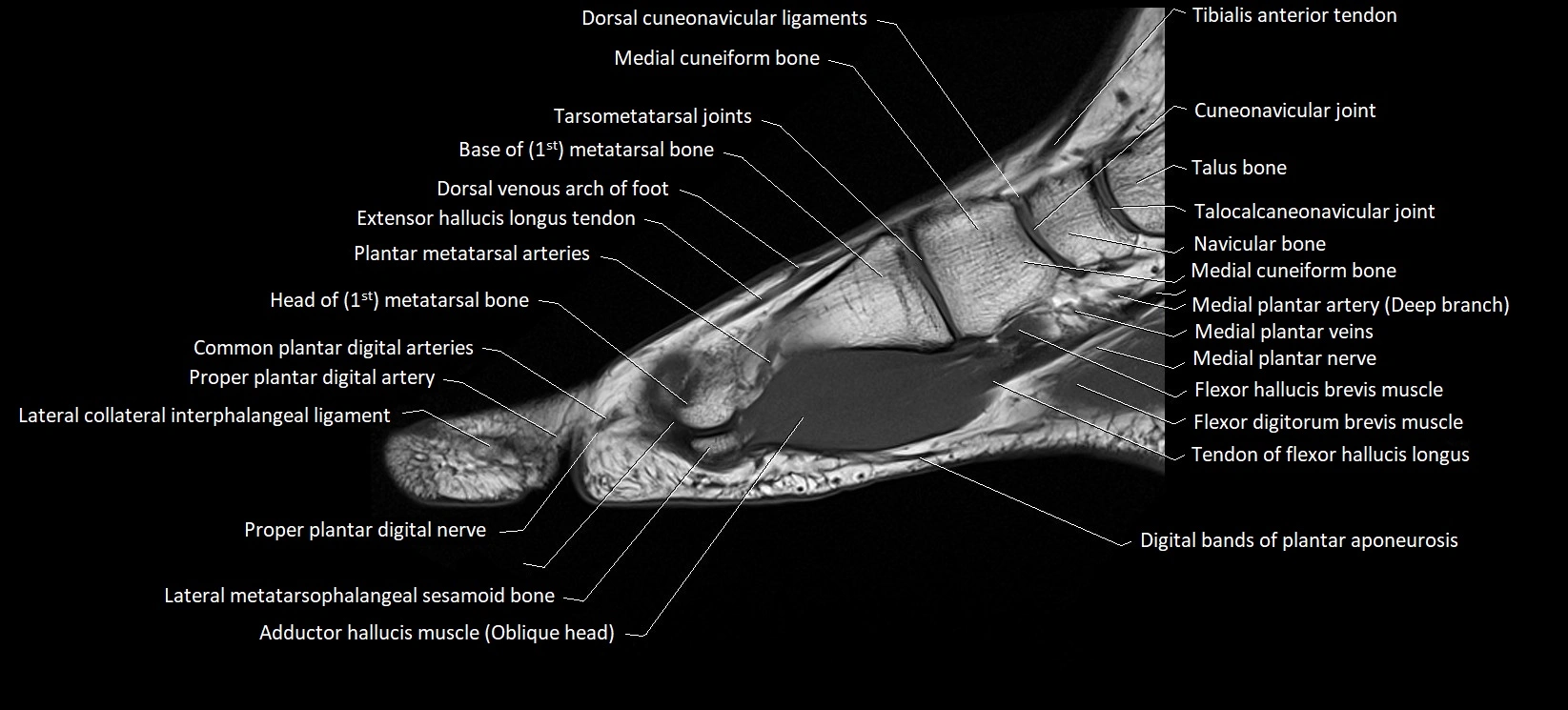 MRI foot sagittal labelled cross sectional anatomy image  8.webp